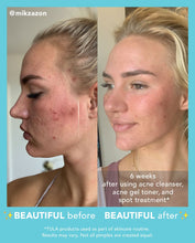 Load image into Gallery viewer, Acne Clearing + Tone Correcting Gel
